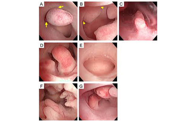 Hysteroscopy Surgery