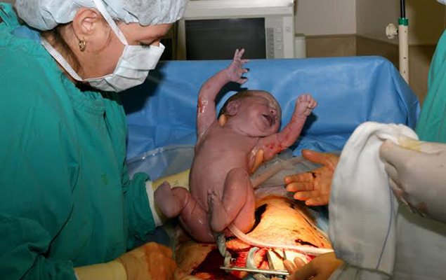 Caesarean